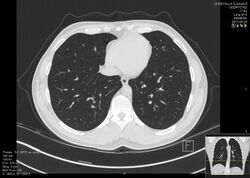 CT cross section, normal chest