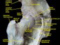 Femoral head