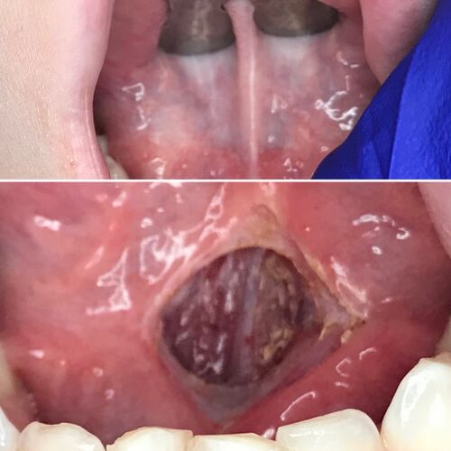 Lingual Frenectomy - Before and After