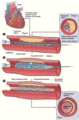 Restenosis