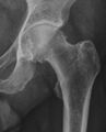 Pincer impingement