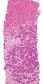 Adenocarcinoma liver metastasis