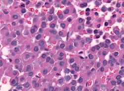 Densely granulated HGH producing adenoma