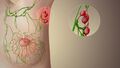Swollen Lymph Nodes
