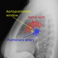 Diagram showing the aortopulmonary window.