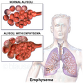Diagram of emphysema