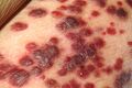Kaposi's Sarcoma lesions, a type of cancer often associated with AIDS.