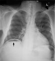 Pneumoperitoneum modification