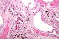 Asbestosis high magnification
