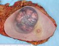 Invasive carcinoma of no special type