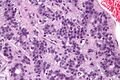 Very high magnification of adenomyoepithelioma