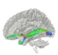 Anterior commissure in a dissected brain