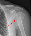 Proximal Humeral Fracture