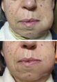 Dental abscess