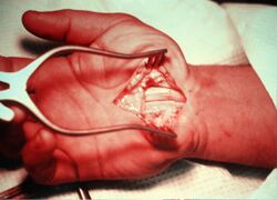 Carpal Tunnel Syndrome