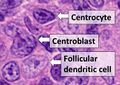 Centrocyte, centroblast and follicular dendritic cell in a follicular lymphoma