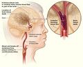 Ischemic stroke illustration