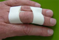 Broken_finger