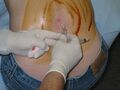 Spinal tap procedure