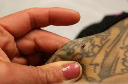 Lone Star Tick Bite