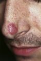 Facial eosinophilic granuloma