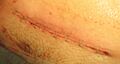 Suturing after C-section
