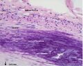 Calcification in atherosclerotic artery