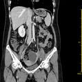 Ovarian Squamous Carcinoma Tumor