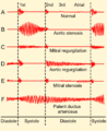 Phonocardiograms from normal and abnormal heart sounds