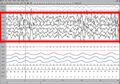 Screen shot of a patient during Slow Wave Sleep
