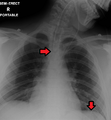 Endotracheal tube and nasogastric tube