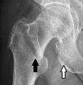 Skin folds close to a hip fracture (with arrows)