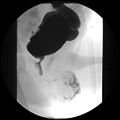Urethral valve