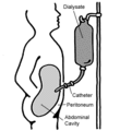 Peritoneal dialysis in Epstein syndrome