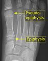 Metatarsal pseudo-epiphysis
