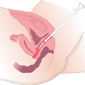 Administering medication vaginally with applicator