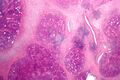 Chronic sialadenitis