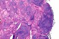 Hashimoto thyroiditis