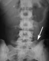 Congenital vertebral anomaly