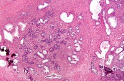 Nodular hyperplasia of the prostate