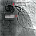 Coronary occlusion