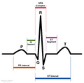 Normal sinus rhythm