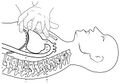 Cardiopulmonary resuscitation