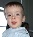 Craniosynostosis