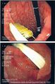 Endoscopic_foreign_body_retrieval