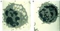 Alpha-mannosidosis electron micrograph