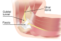 Diagram of a compressed ulnar nerve