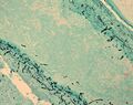 Fungus in brain tissue