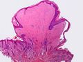 List of vaginal tumors