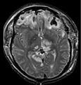 MRI showing brain injury with herniation